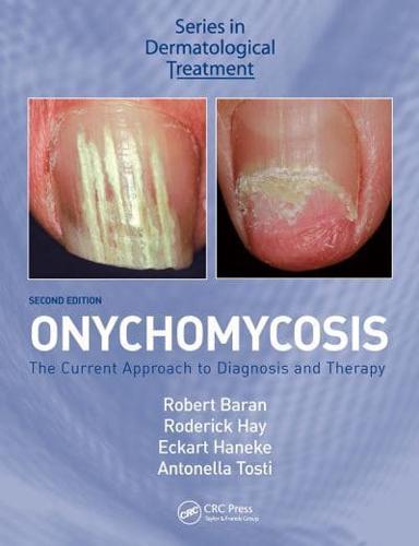 Onychomycosis By:Antonella Tosti Eur:52.02 Ден1:3099